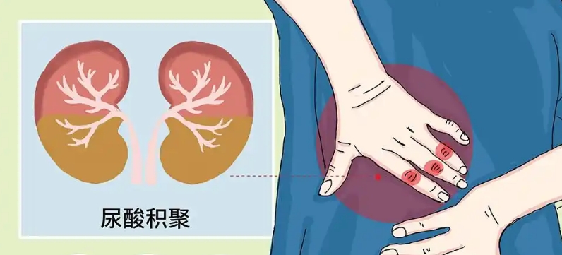 尿酸高的症状表现有哪些？尿酸轻中重都有哪些症状？